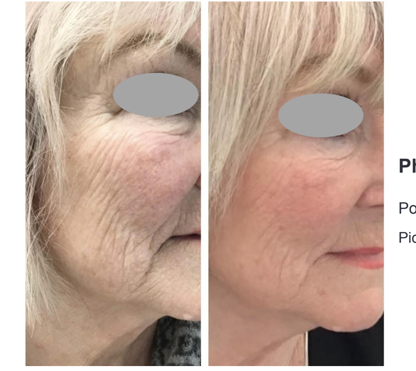 A woman 's face is shown before and after photo aging.