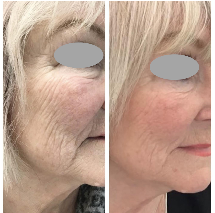 A before and after photo of a woman 's face showing disappearance of lines and wrinkles 