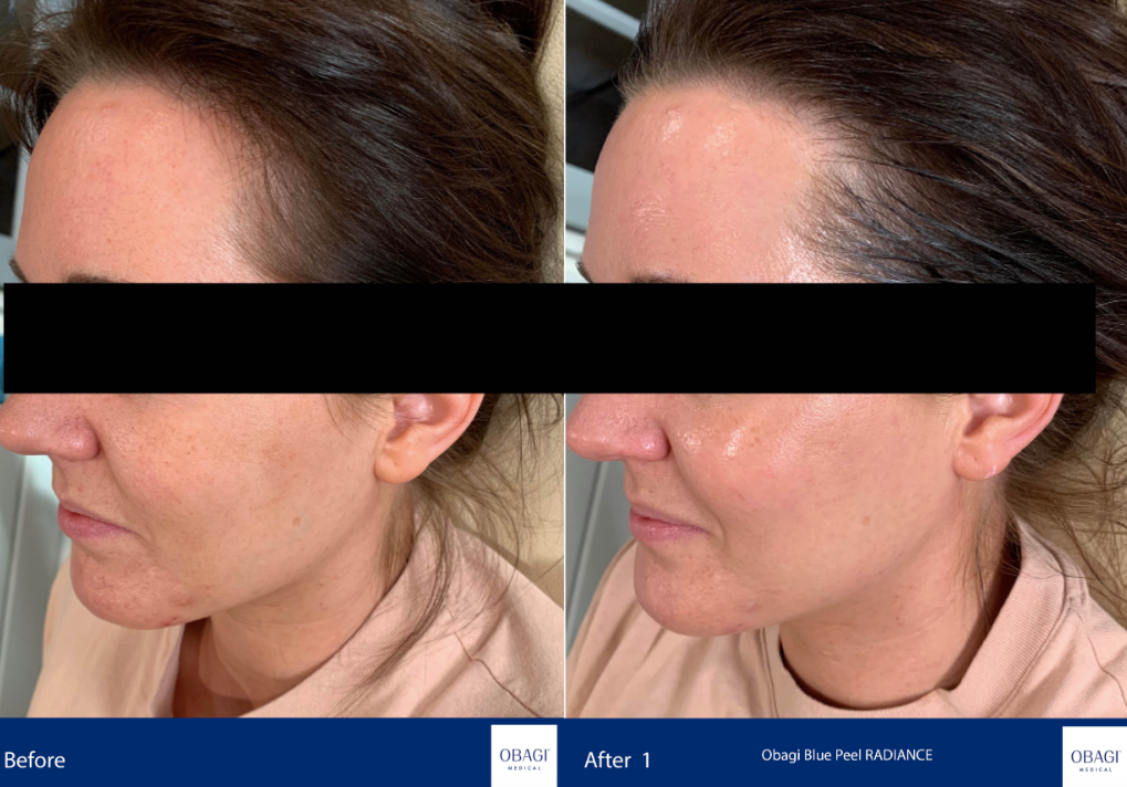 A woman 's face is shown before and after a treatment.