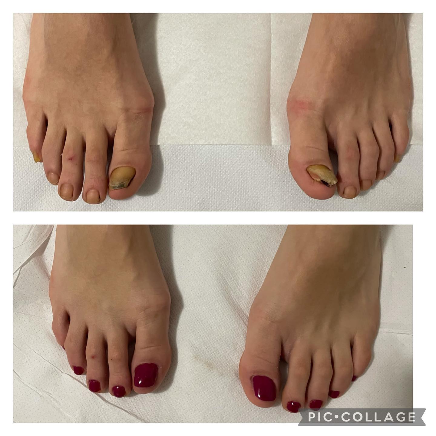 pedicure prima e dopo