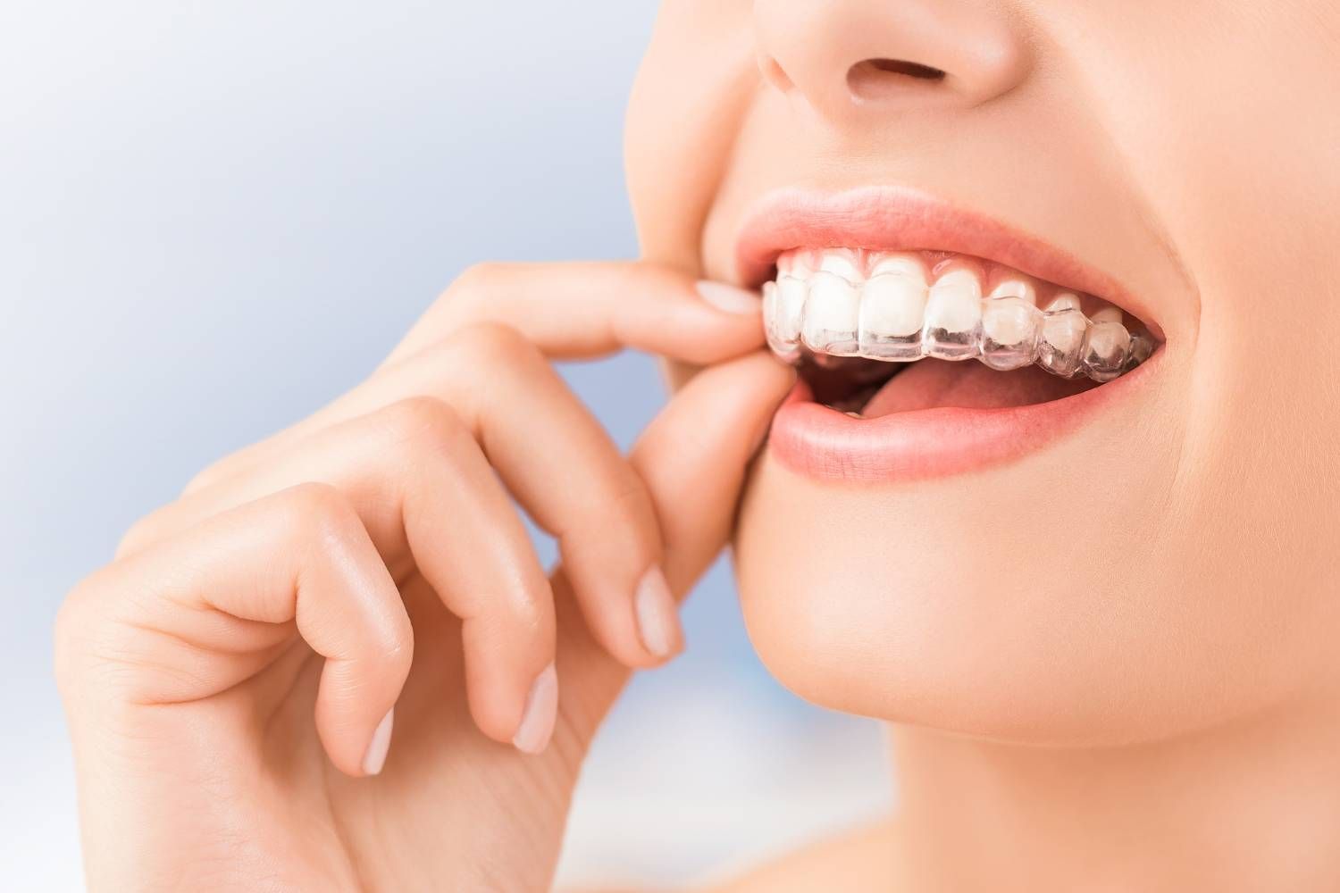 Invisalign+treatment-1920w.jpg