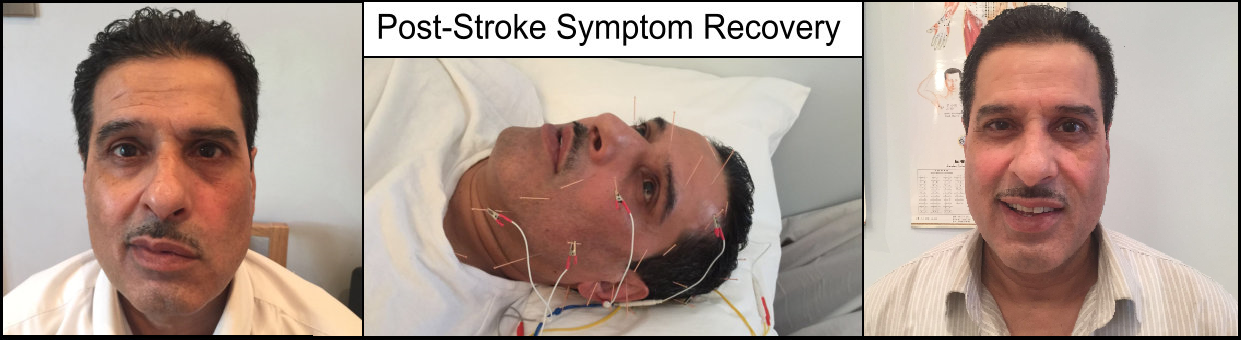Post-stroke symptom recovery