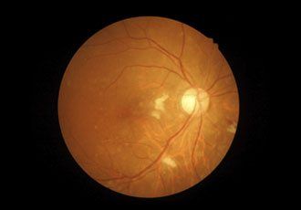 Retinal and Optic Nerve - Cataract Treatment in Doylestown, PA