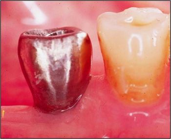 Un primo piano di due corone di denti su uno sfondo rosso