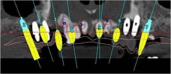 Un'immagine generata al computer dei denti di una persona