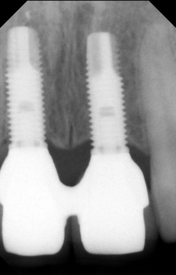 Una radiografia in bianco e nero di un dente con due impianti dentali.