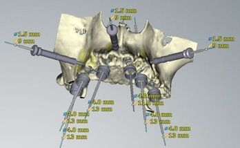 Un'immagine generata al computer di un teschio con molti buchi