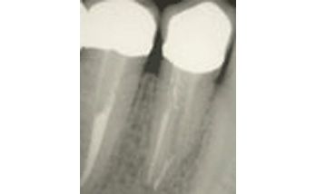 Una radiografia di un dente con un buco.