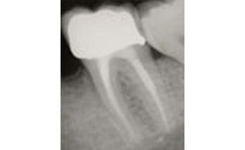 Una radiografia in bianco e nero di un dente con un buco.