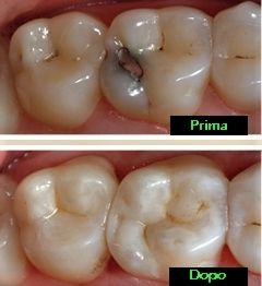 Una foto dei denti di una persona prima e dopo.