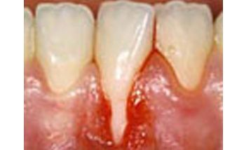 Un primo piano dei denti di una persona a cui manca un dente