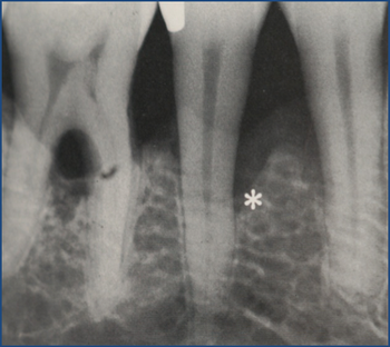 Una foto in bianco e nero dei denti di una persona con una stella al centro