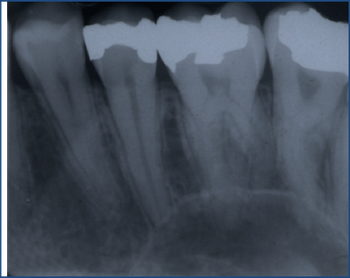 Una radiografia dei denti di una persona mostra un dente con un buco.