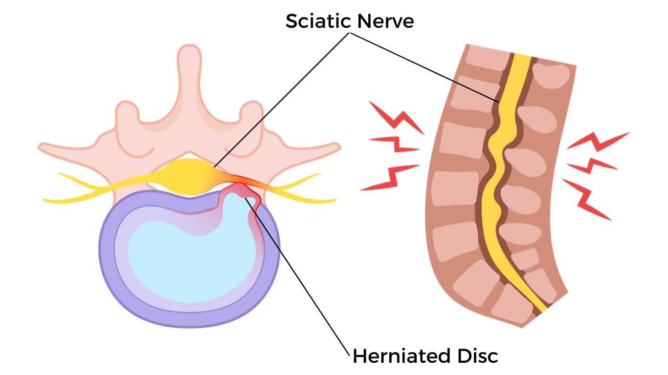 Causes and Symptoms of Sciatica