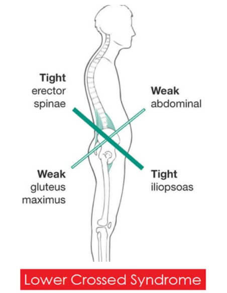 Lower cross syndrome