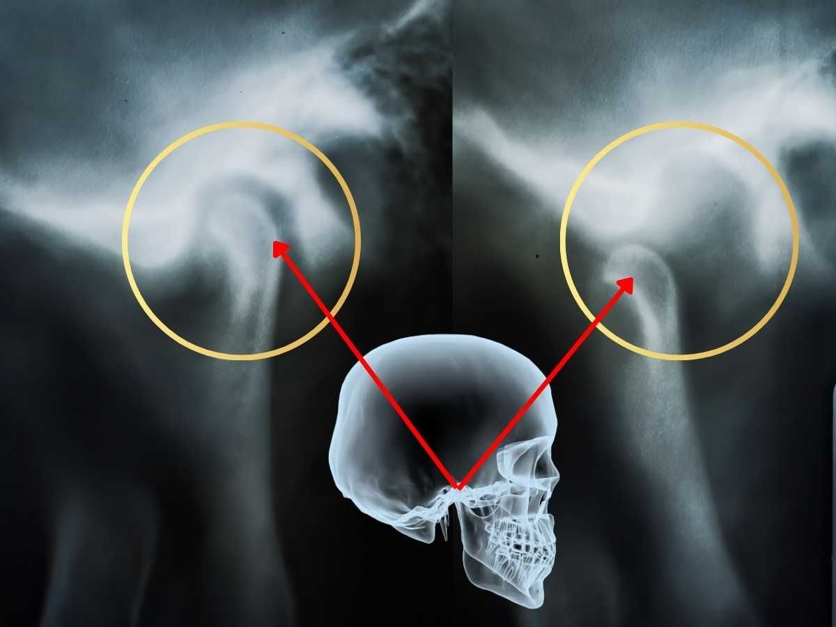 Temporomandibular Joint Disorder (TMJ)