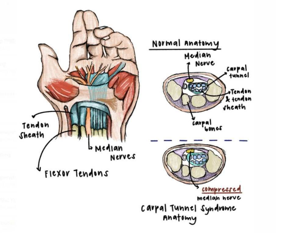 Carpal Tunnel Syndrome