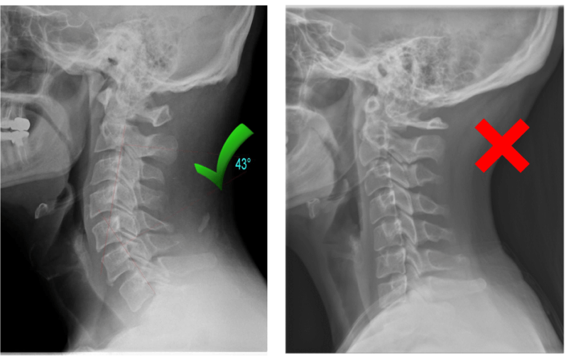 Get help with restoring your cervical curve - One Spine