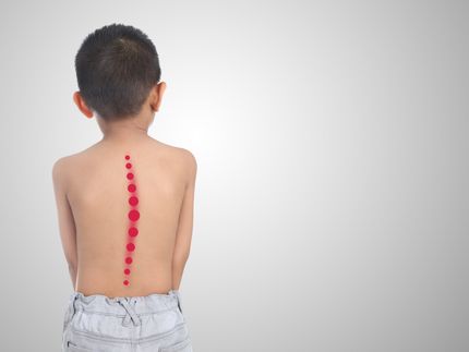 Scoliosis Scoliosis