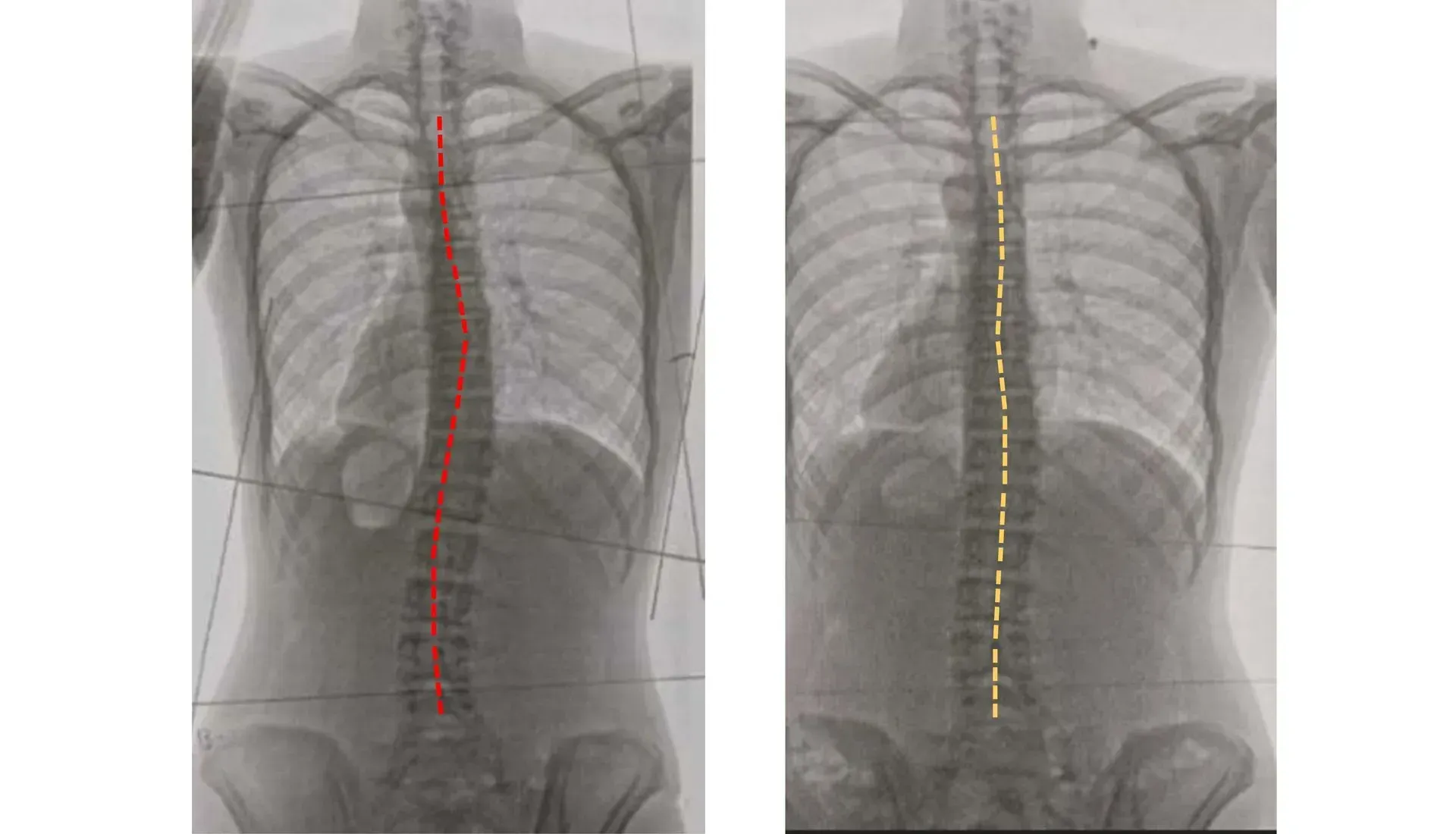 Testimonial_Real Results, Real Stories x ray of a scoliosis patient