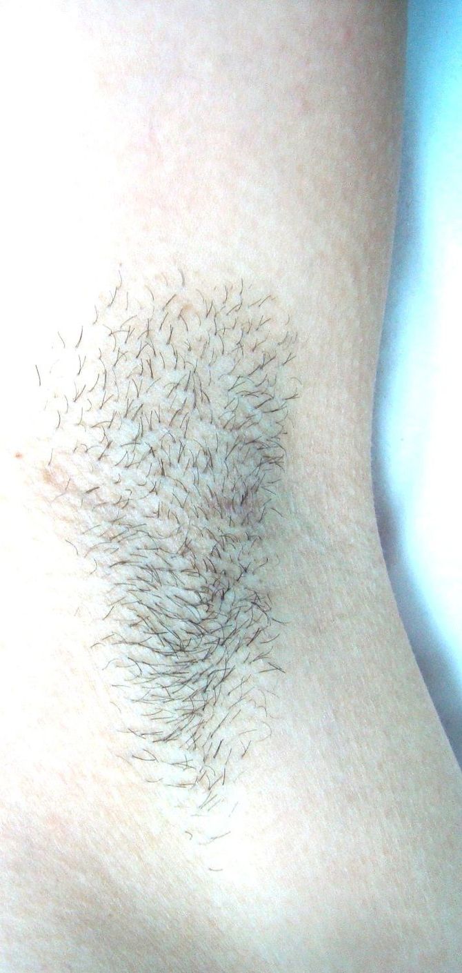 Axilas com crescimento natural de pelos e sinais de foliculite antes do tratamento de depilação a laser.