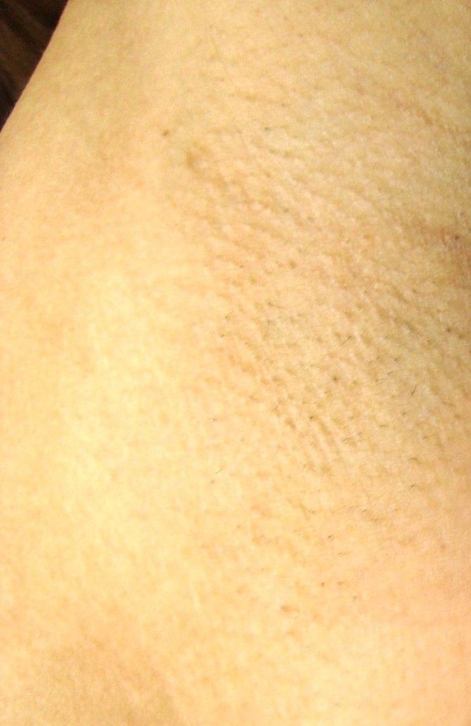 Resultado de axilas femininas lisas, claras e sem pelos após 5 sessões de depilação a laser.