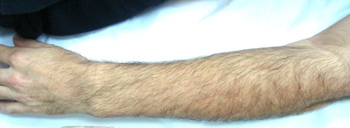 Braço masculino com crescimento natural de pelos  antes do tratamento de depilação a laser.