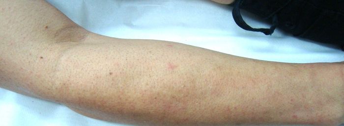 Braço masculino após 6 sessões de depilação a laser
