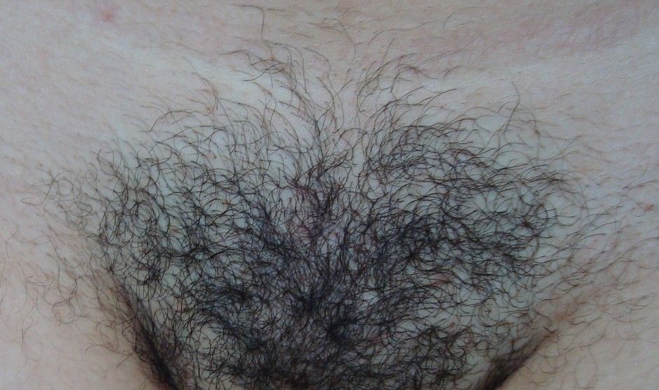 Região da virilha com pelos aparentes antes de iniciar as sessões de depilação a laser.