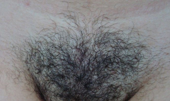 Região da virilha com pelos aparentes antes de iniciar as sessões de depilação a laser.