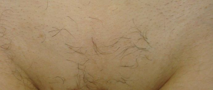 Resultado de virilha lisa, macia e sem encravamentos após 5 sessões de depilação a laser.