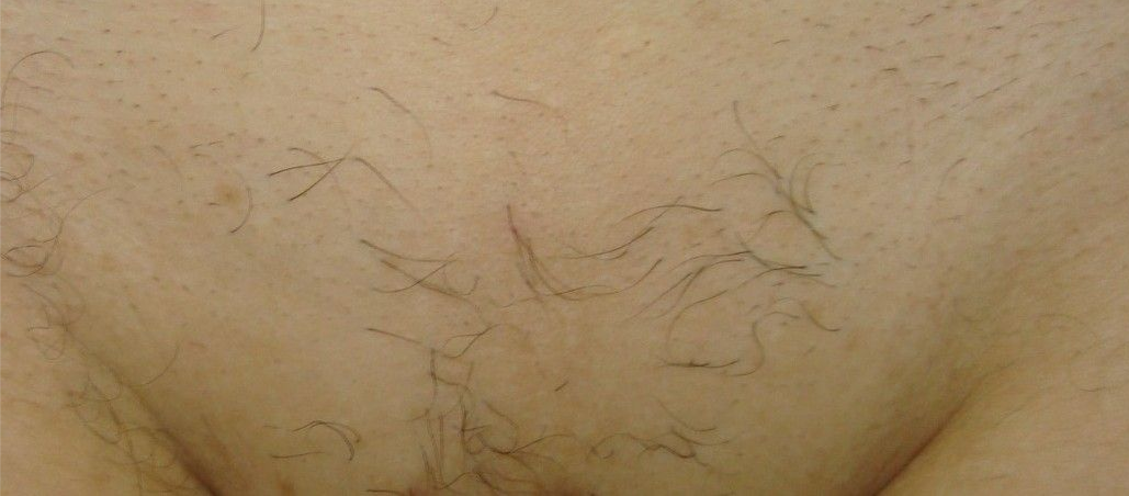 Resultado de virilha lisa, macia e sem encravamentos após 5 sessões de depilação a laser.