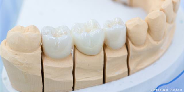 Zahnersatz: Zahnkronen, Zahnbrücken, Teilprothesen und Totalprothesen