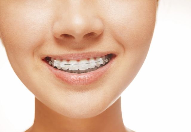 Teeth Straightening Procedures From a Dentist