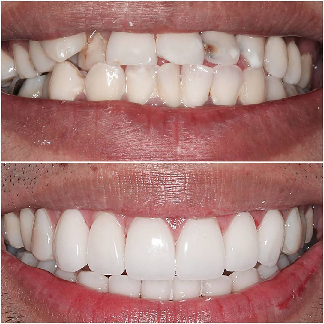 SMILE GALLERY - TLC Dental Wellness