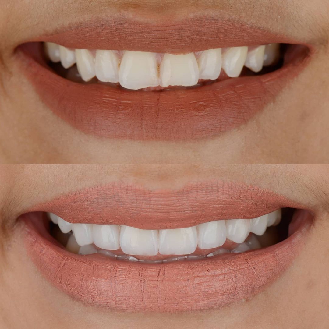 SMILE GALLERY - TLC Dental Wellness