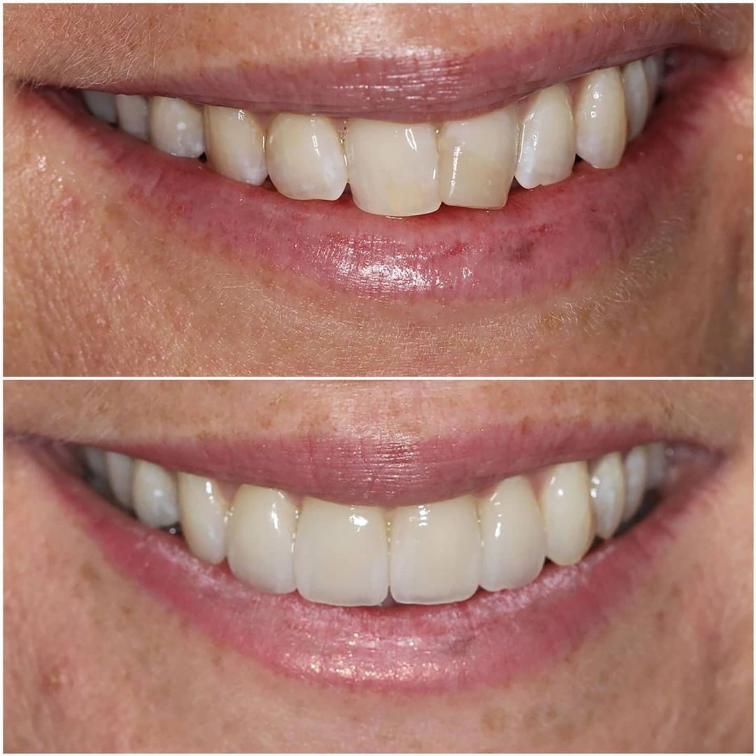 SMILE GALLERY - TLC Dental Wellness