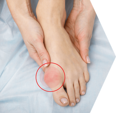 Bunion and Hammer Toe Surgery in Singapore