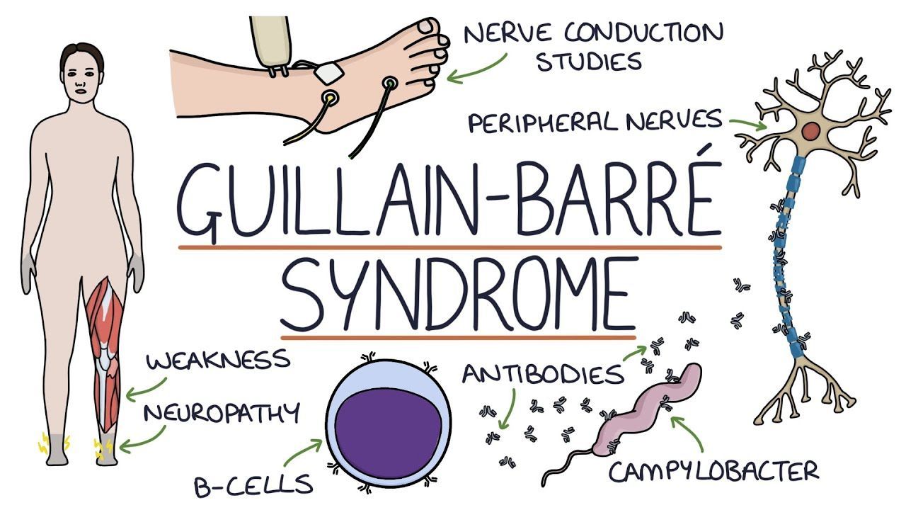 Guillian-Barre Syndrome | Fort Worth, TX | Drawing of Guillian Barre Syndrome Problems and Locations on the Body