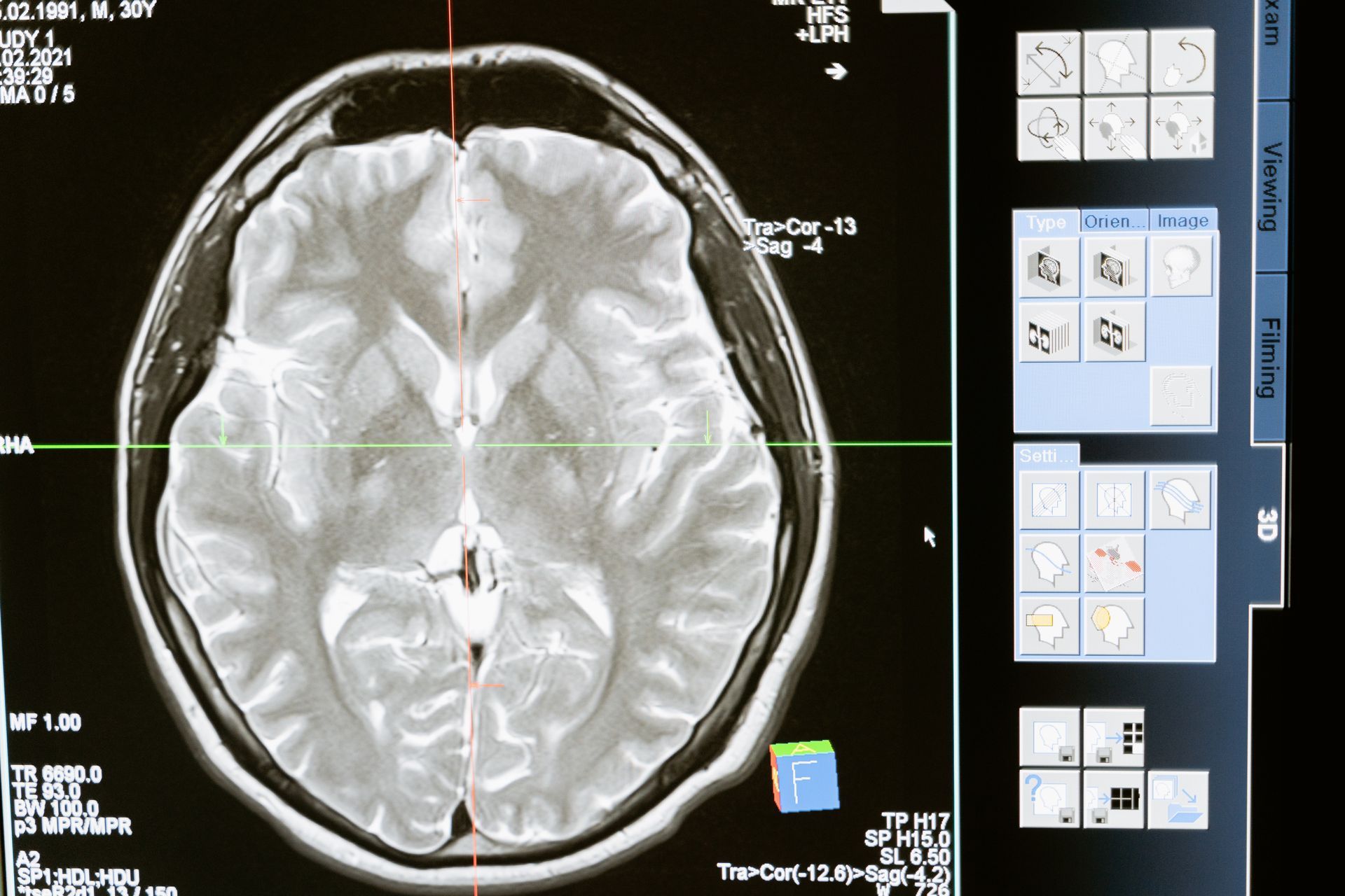 Brain Injury | Fort Worth, TX | Brain Scan Image on a screen
