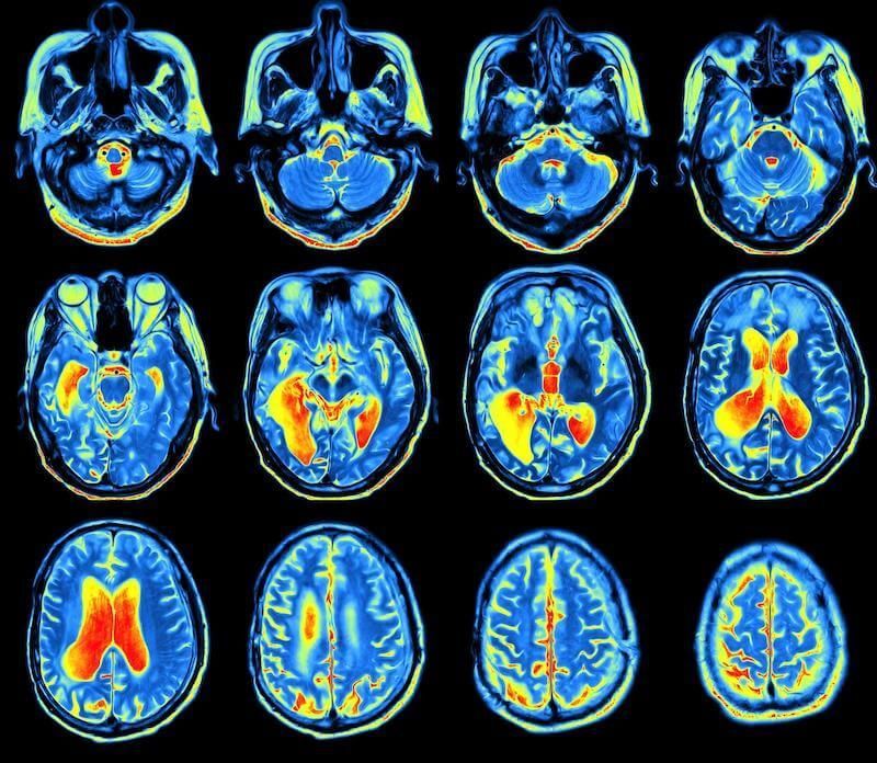 MRI image of head and brain looking for brain injury and trama