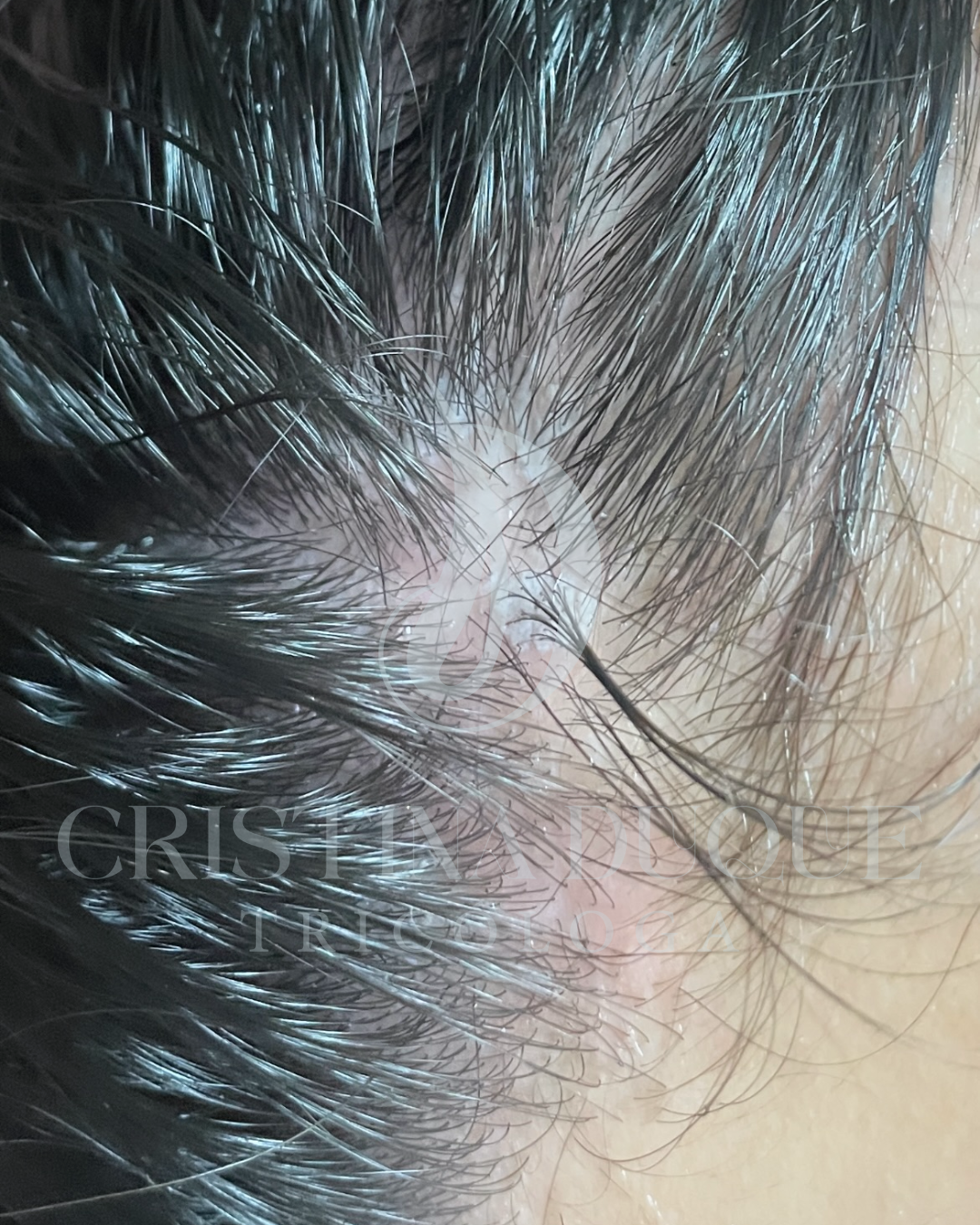 dermatitis seborreica 