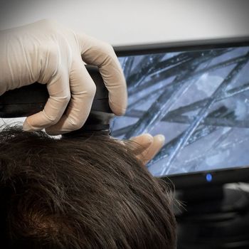 Examen tricológico del cuero cabelludo con dermatoscopio