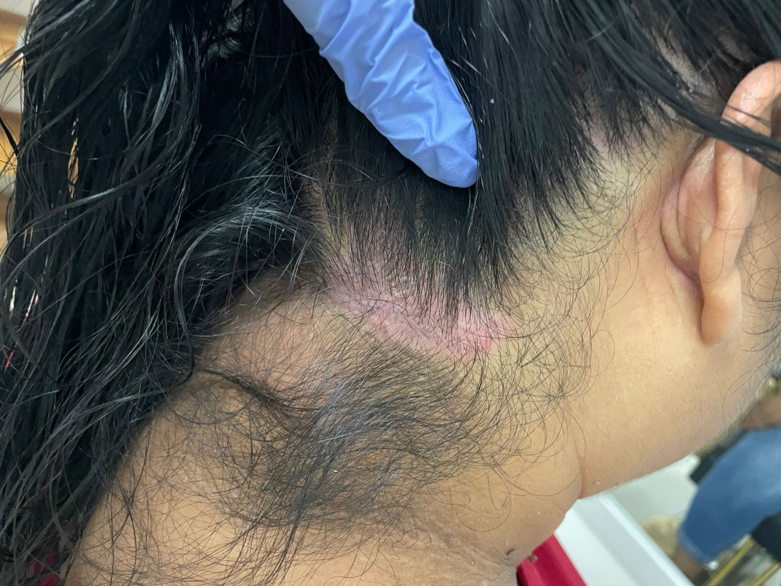 dermatitis seborreica
