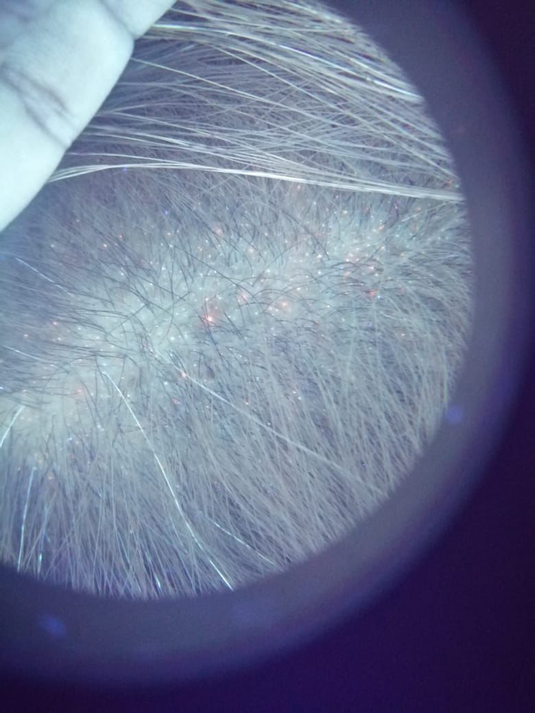 exceso de hongos y cuero cabelludo graso