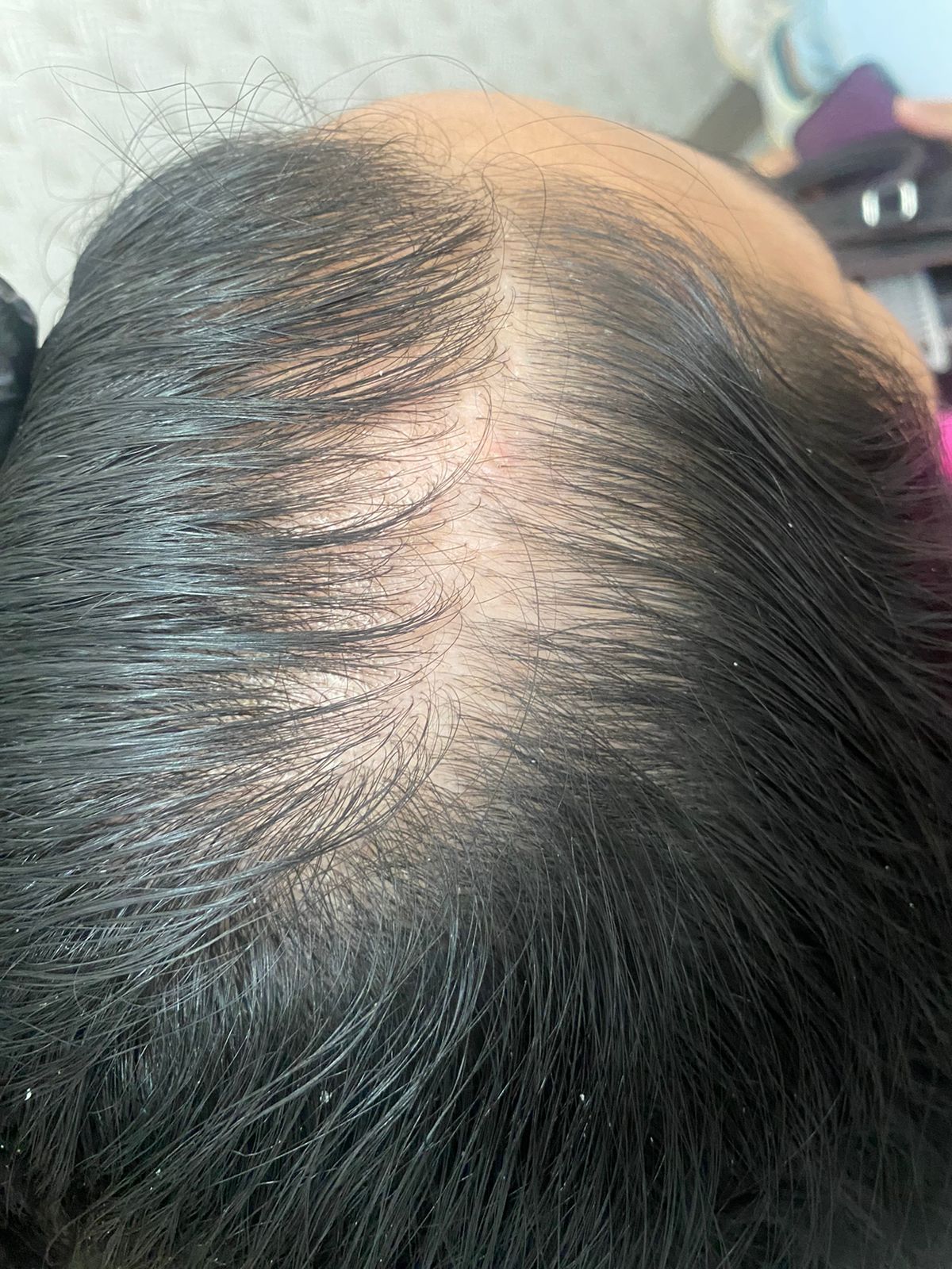 alopecia androgenetica y trofica