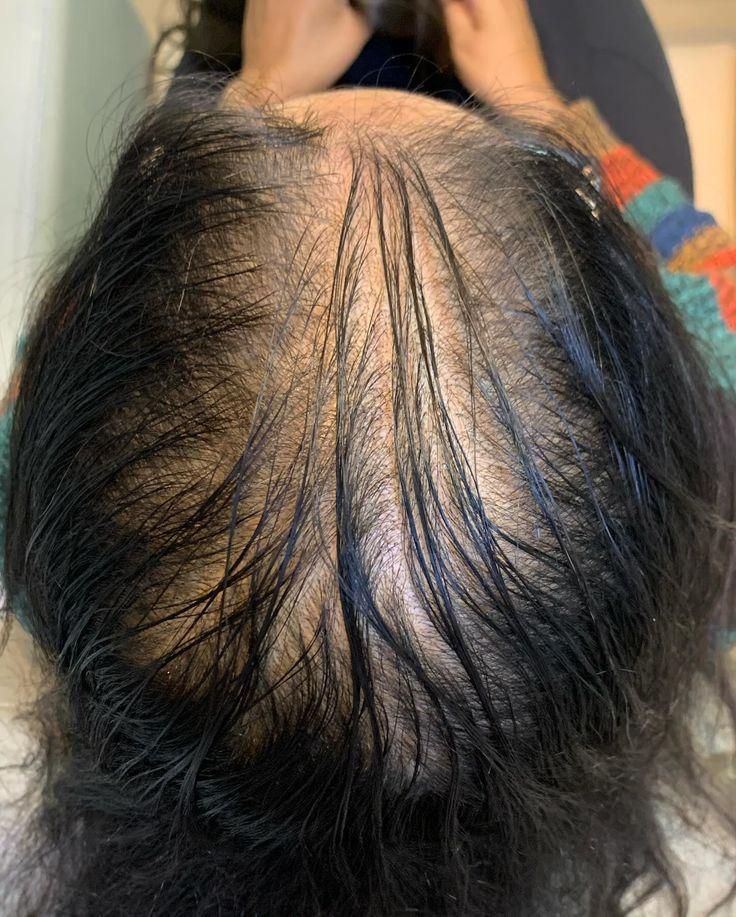 Alopecia femenina, caída de cabello visible en la coronilla alopecia androgenetica
