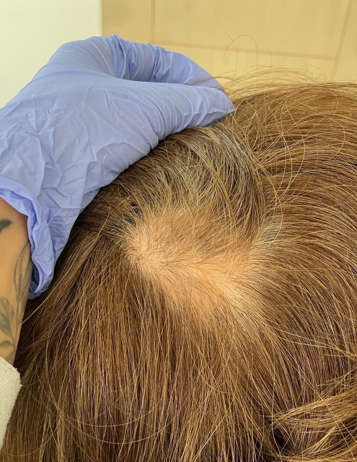 dermatitis-seborreica-cuero-cabelludo.jpg