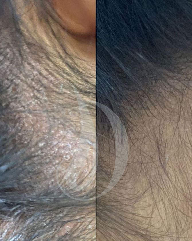 dermatitis seborreica