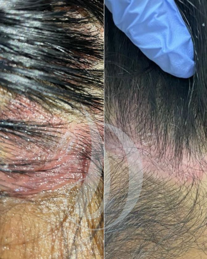 dermatitis seborreica 
